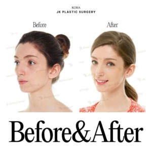 JK Plastic Surgery_Rhinoplasty Canada