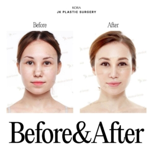 JK Plastic Surgery_Rhinoplasty Russia