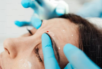 injection areas
