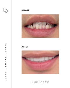 veneer before after6