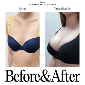Lavian Plastic Surgery_Breast augmentation 2