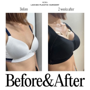 Lavian Plastic Surgery_Breast augmentation 4