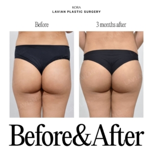 Lavian Plastic Surgery_Buttock fat grafting 4