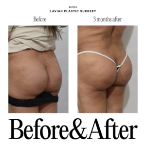 Lavian Plastic Surgery_Buttock fat grafting 5