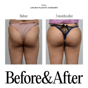 Lavian Plastic Surgery_Buttock fat grafting 3