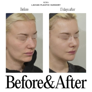 Lavian Plastic Surgery_Face lift 5