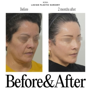 Lavian Plastic Surgery_Face lift 4