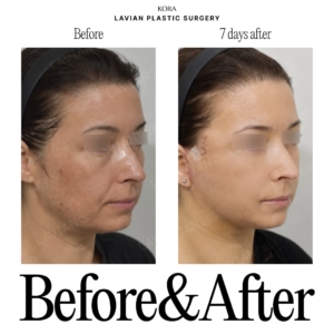 Lavian Plastic Surgery_Face lift 1