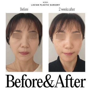 Lavian Plastic Surgery_Face lift 2