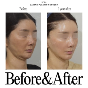 Lavian Plastic Surgery_Facial lift revision surgery 3