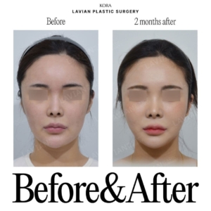 Lavian Plastic Surgery_Facial contouring surgery 1