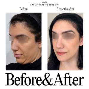 Lavian Plastic Surgery_Facial Contouring Surgery 3