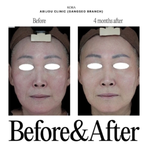 Abijou Clinic (Gangseo branch)_Skin laser