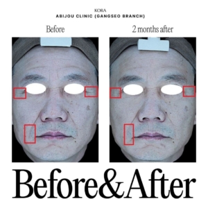 Abijou Clinic (Gangseo branch)_Laser lifting