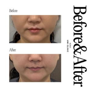 Dr. Jong Woo Yoon_Nasolabial fold filler