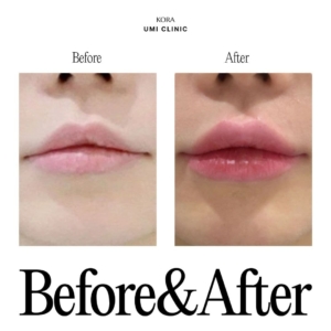 Dr. Jong Woo Yoon_Lip filler