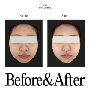 Dr. Jong Woo Yoon_Marionette filler