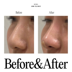 Dr. Jong Woo Yoon_Nose filler