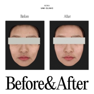 Dr. Jong Woo Yoon_Pigment laser