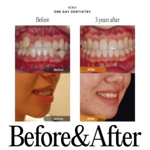 ONE DAY Dentistry_Non-extraction orthodontic treatment