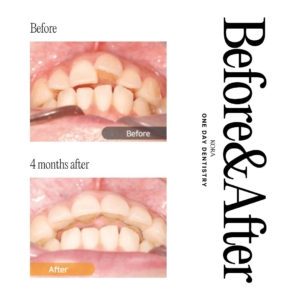 ONE DAY Dentistry Maxillary Anterior partial orthodontic treatment 1
