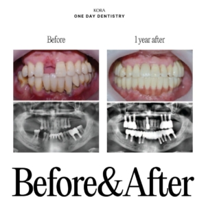 ONE DAY Dentistry Lower Full-Arch Implant Treatment, Single Dental Implant