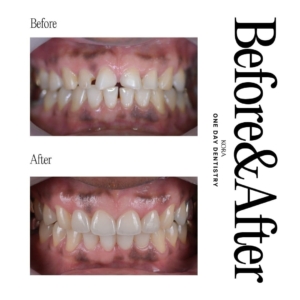 ONE DAY Dentistry_Dental veneers 2