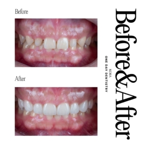 ONE DAY Dentistry_Dental veneers 1
