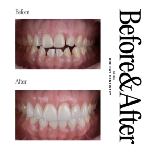 ONE DAY Dentistry_Dental veneers 3