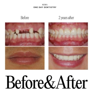 ONE DAY Dentistry before and after Dental Implant 1