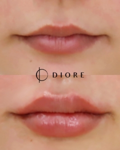 diore BA1