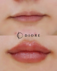 diore BA3