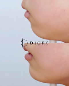 diore BA6