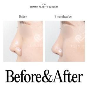 Dr. Sung Kee Min_Revision rhinoplasty 2-2