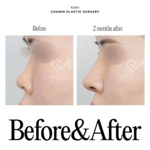 Dr. Sung Kee Min_Autologous rib cartilage revision rhinoplasty 1-2