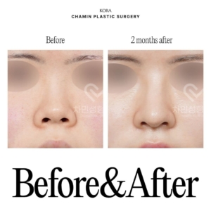 Dr. Sung Kee Min_Autologous rib cartilage revision rhinoplasty 1