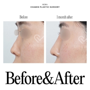Dr. Sung Kee Min_Autologous Rib Cartilage Revision Rhinoplasty 2-2