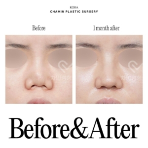 Dr. Sung Kee Min_Revision rhinoplasty 1