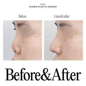Dr. Sung Kee Min_Revision rhinoplasty 1-2