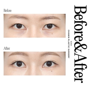 Dr. Wook Soo Chae_Fat grafting