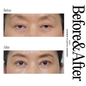 Dr. Wook Soo Chae_Upper blepharoplasty, Ptosis correction
