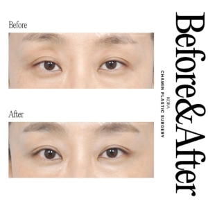 Dr. Wook Soo Chae_Upper blepharoplasty, Ptosis correction, Fat grafting