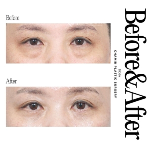 Dr. Wook Soo Chae_Lower blepharoplasty