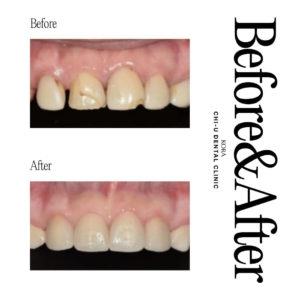 Gangnam Chi-U Dental Clinic_Dental veneers 3