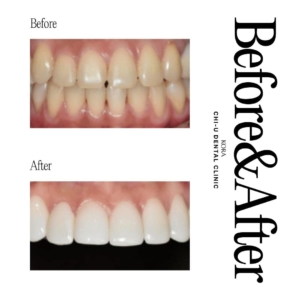 Gangnam Chi-U Dental Clinic_Dental veneers 4