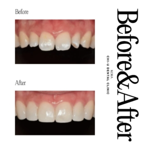 Gangnam Chi-U Dental Clinic_Dental veneers 1