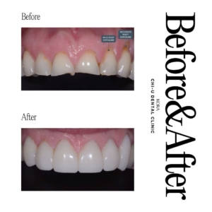 Gangnam Chi-U Dental Clinic_Dental composite bonding